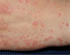 Scabies skin rash