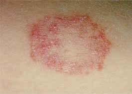 Successful Treatment of Fungal Groin Infection and Tinea Cruris