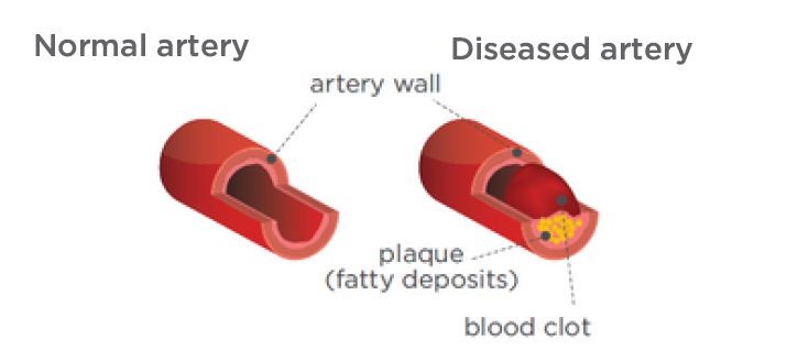 Heart Health | National Centre for Farmer Health